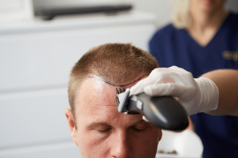 Best Hair Transplant Technologies in India