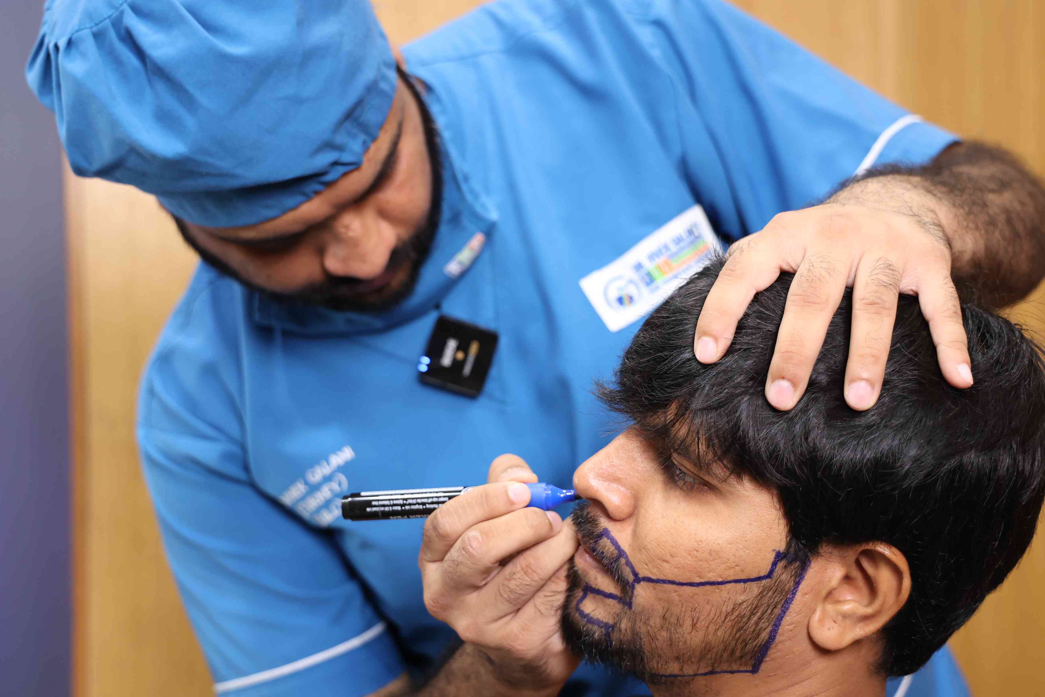 Best Beard Hair Transplant in India