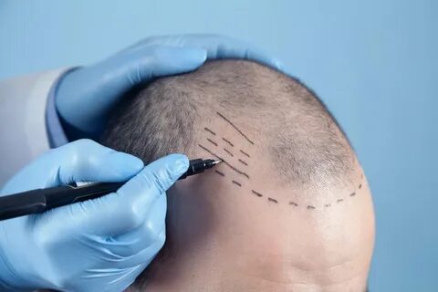 hair transplant correction in Surat