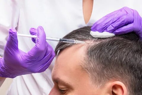 best hair transplant correction doctor in Surat