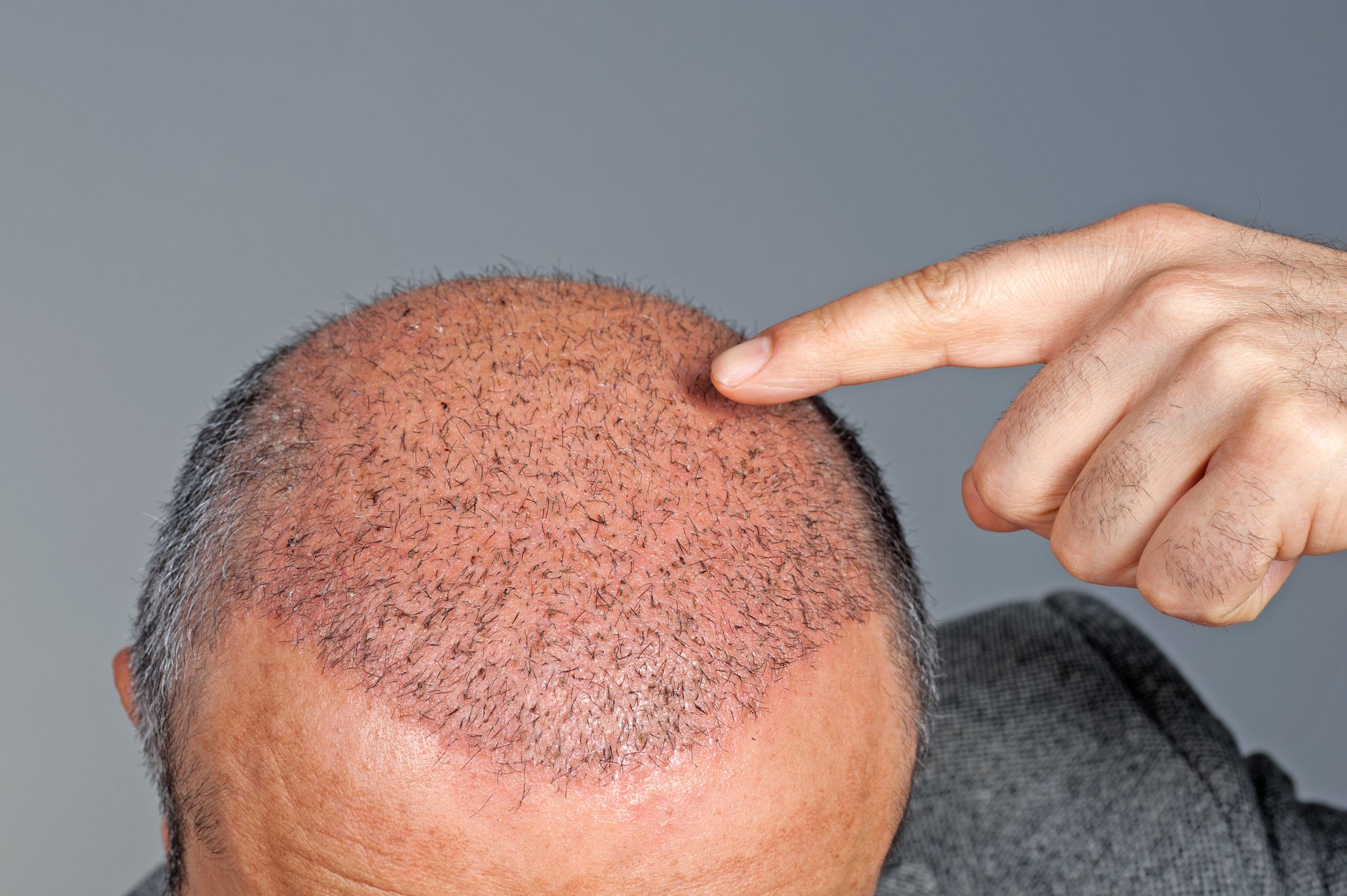 hair transplant cost in india