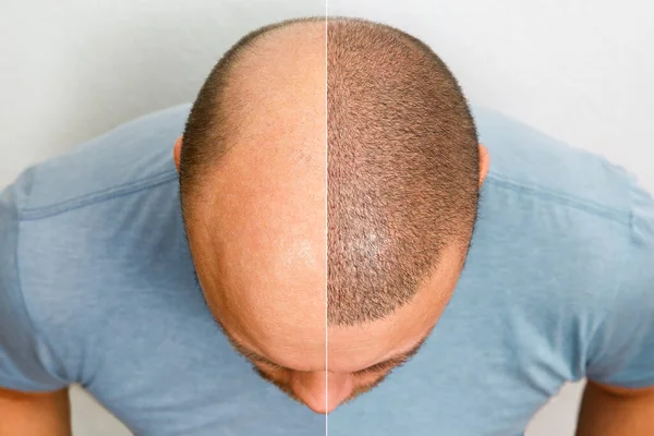 Which One is the Best: Hair Loss Medication vs Hair Transplant Treatment?