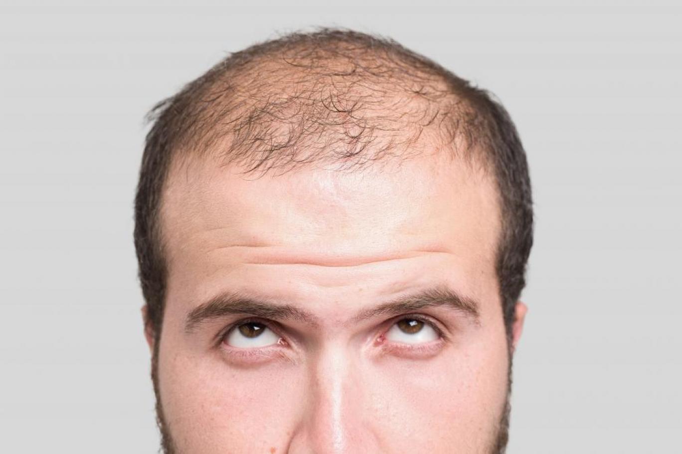 Permanent Solution for Male Pattern Baldness