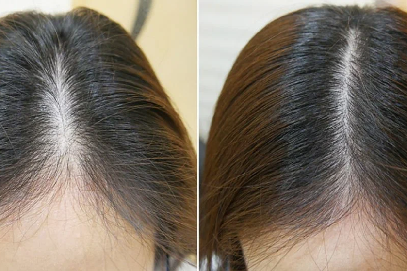 best hair regrowth treatments in India