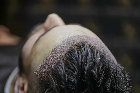 Best Hair Transplant Treatment in India