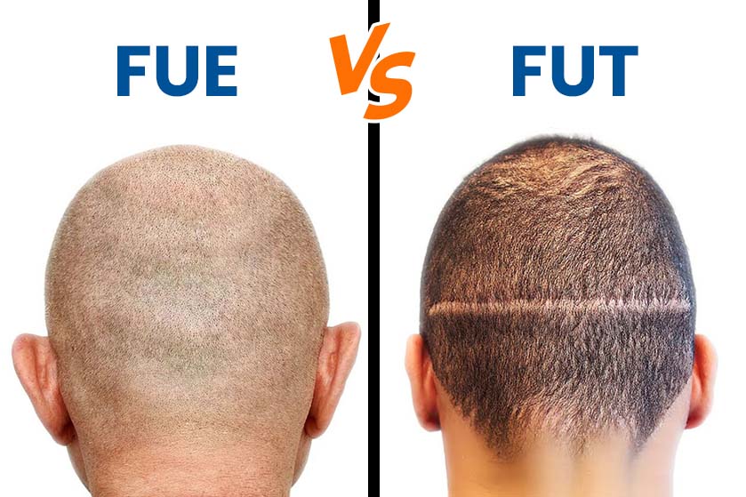 Best hair transplant method: FUE vs FUT