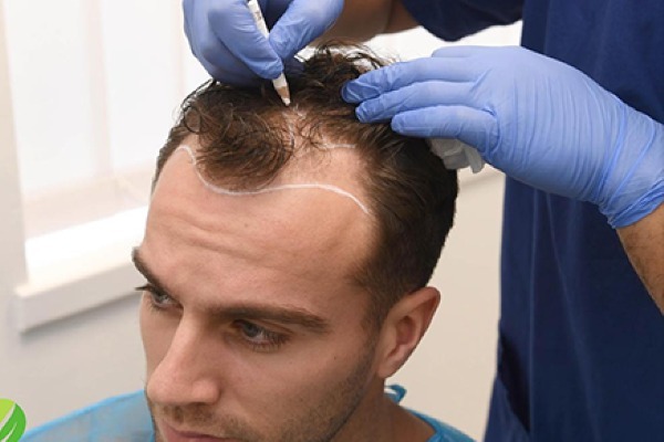 Best Hair Transplant Correction