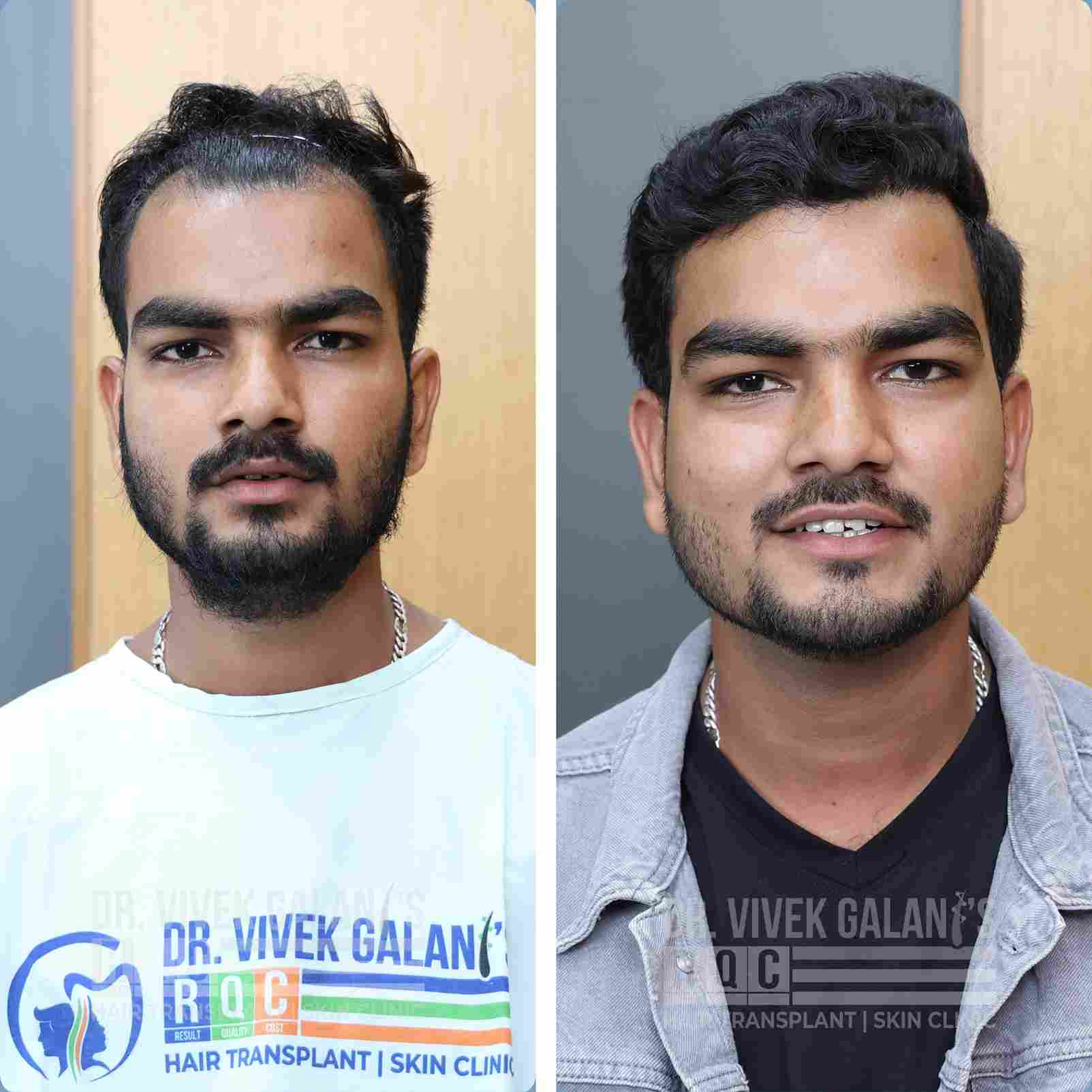 Aniket Shivkumar Gupta After Before