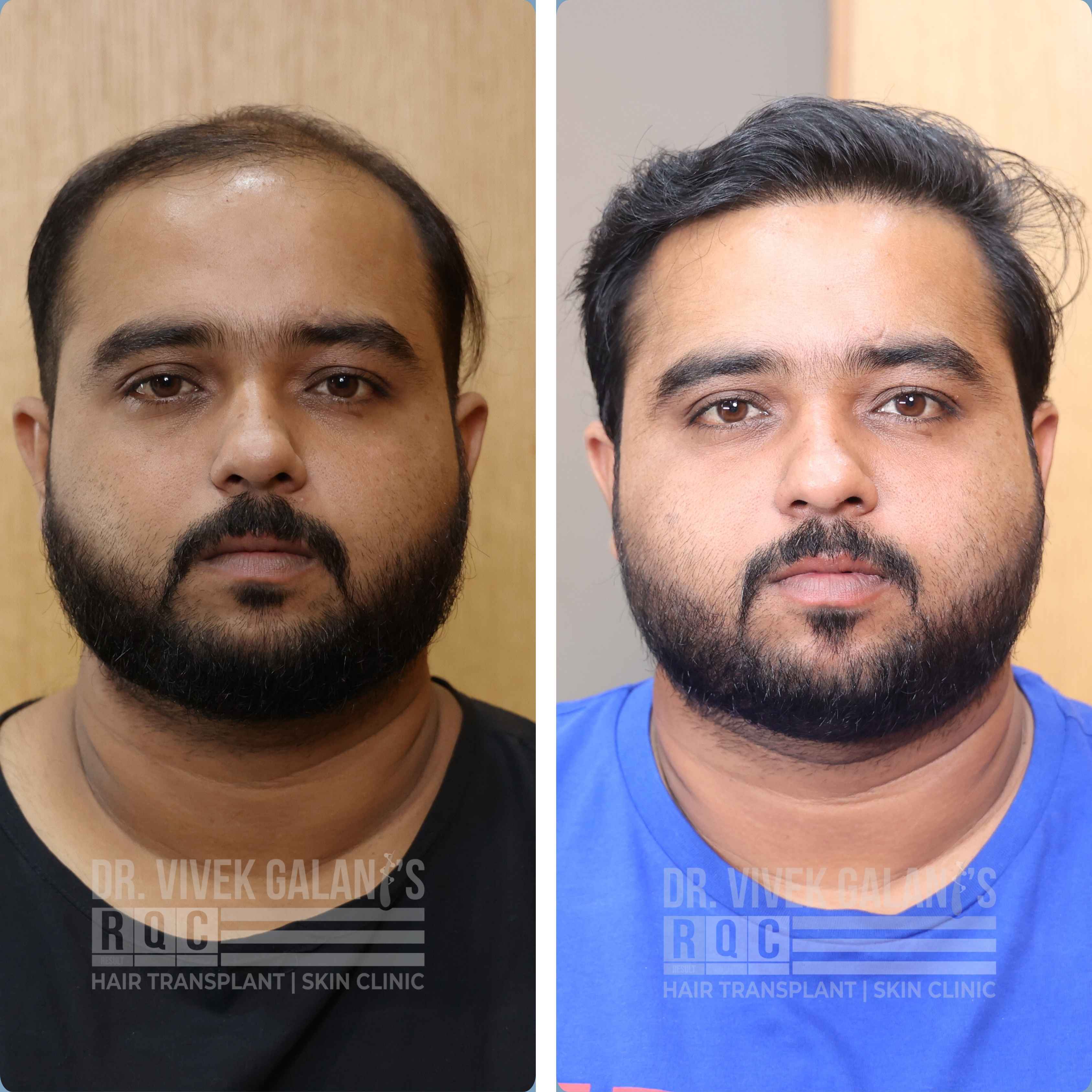 Jay Harshad Tikiwala before   after