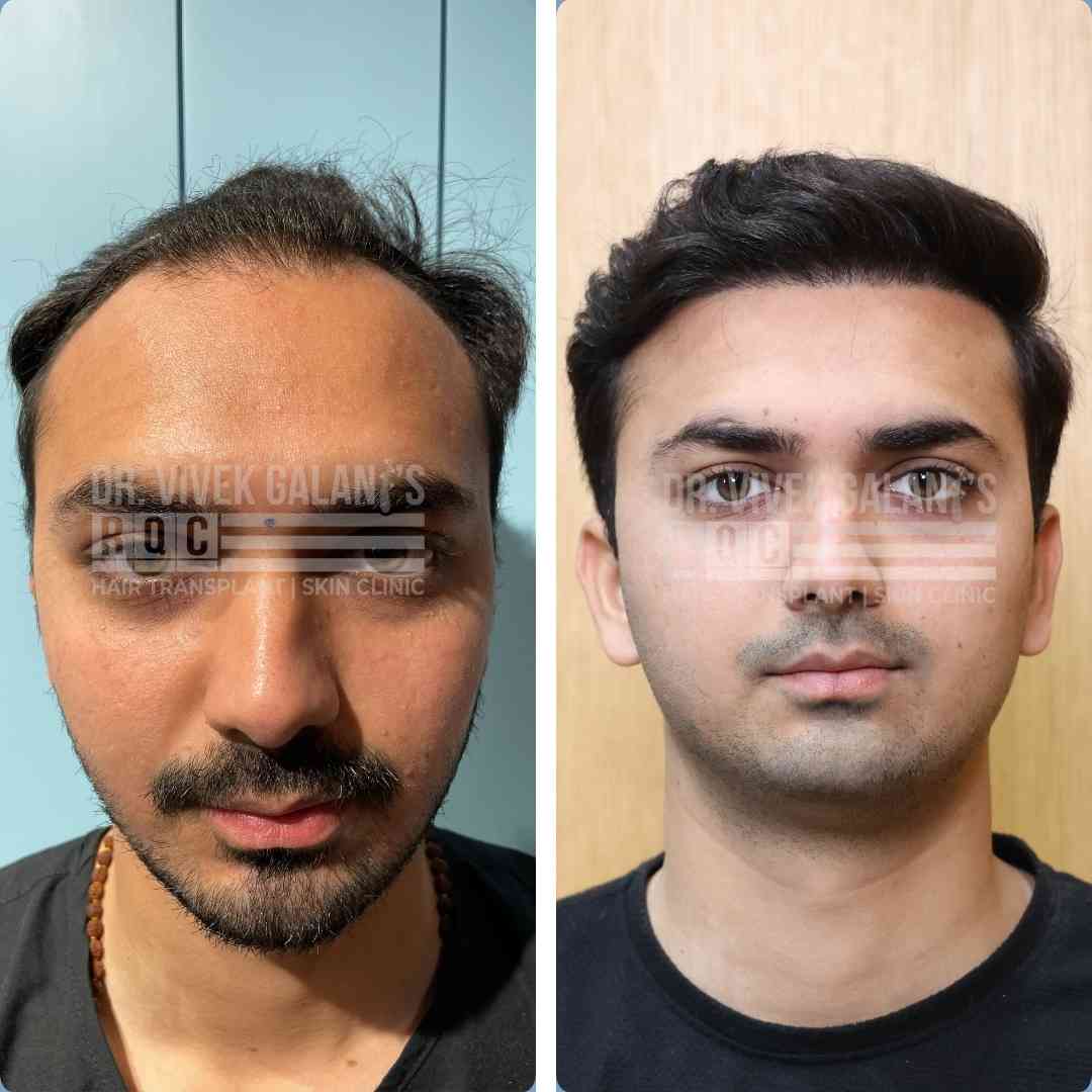 Follow Up Care for 1 Year